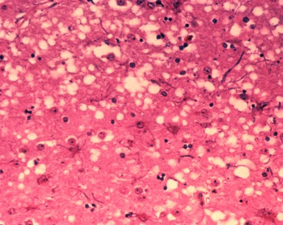 Das Bild zeigt die histopathologischen Veränderungen, die bei einer Infektion mit BSE auftreten. (Bild Dr. Al Jenny)