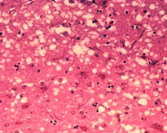 86375976c25ea3c491216411e858b31a85605b66 Das Bild zeigt die histopathologischen Veränderungen, die bei einer Infektion mit BSE auftreten. (Bild Dr. Al Jenny)
