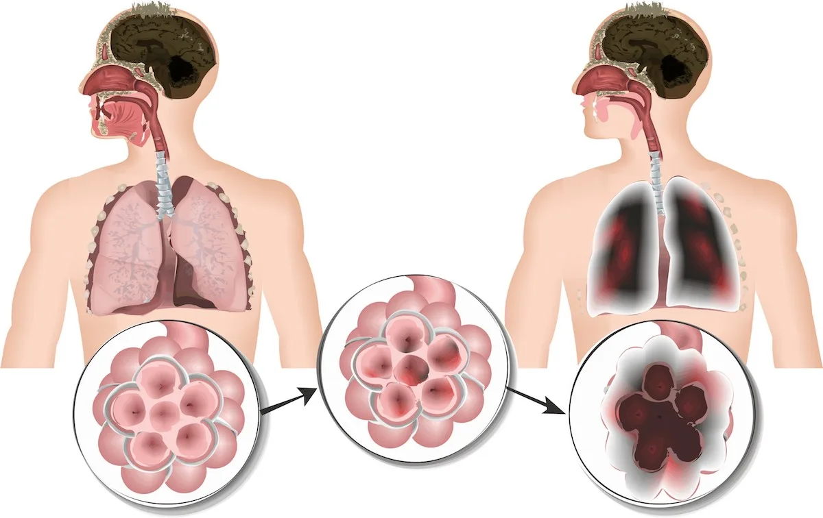 ecba0b8f405611ea227a9d58ec18fa186753ffe3 In den Lungenbläschen findet der Gas-Austausch statt. rechts eine gesunde Lunge, links eine Lunge mit COPD. Schädliche Partikel führen zu Entzündungen der Schleimhäute der Lungenbläschen. Rechts zu sehen: Die Membrane brechen zusammen. Bild: Fotolia